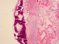 Prostaatkapselcyste met metaplastische botvorming 4X.jpg